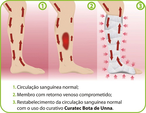 Imagem Curativo Curatec Bota de Unna